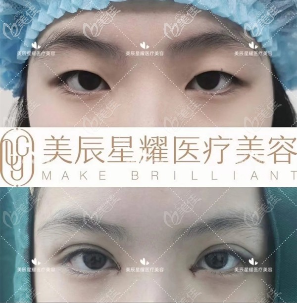 ​成都江涛医生做双眼皮怎么样？提肌+开眼角+全切去皮去脂双眼皮案例了解下