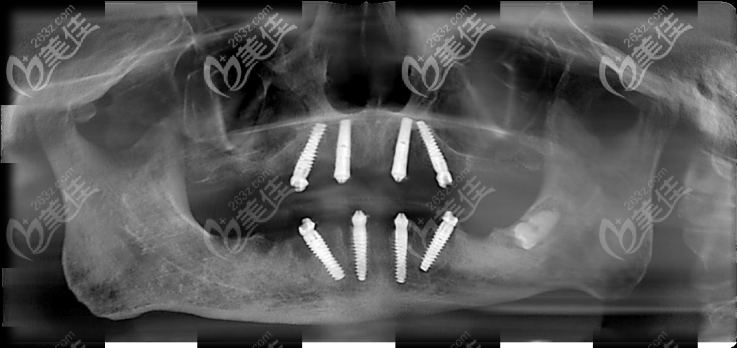 70岁老人在马泷齿科做allon4满口种植牙后的CT 70岁老人在马泷齿科做allon4满口种植牙后的CT