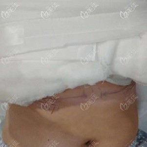 隆胸术后包裹的很严实 隆胸术后包裹的很严实