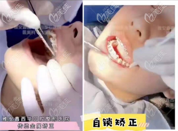 雅安鑫西华口腔医院牙齿矫正