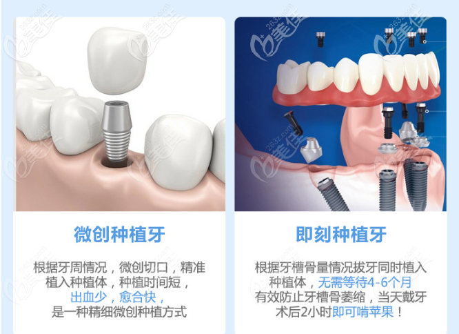 种植牙手术有几种方式