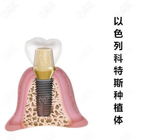 以色列科特斯cortex种植体