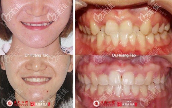 反颌矫正前后的正面脸型照和牙齿图 反颌矫正前后的正面脸型照和牙齿图
