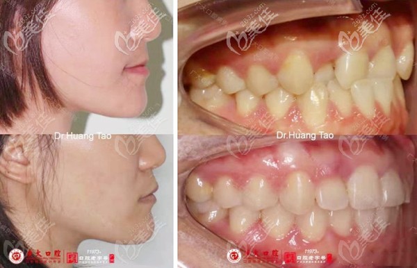 地包天矫治前后脸型的改变图 地包天矫治前后脸型的改变图