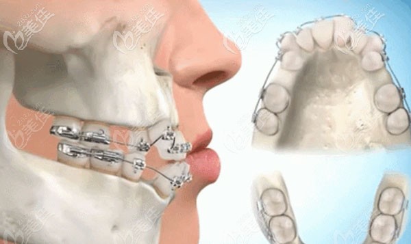 动画图演示矫牙是如何改变脸型的 动画图演示矫牙是如何改变脸型的