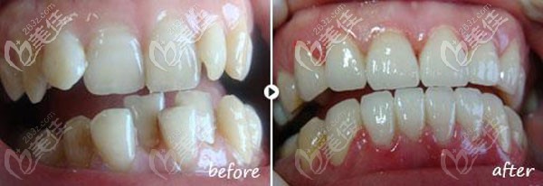 牙齿矫正图片前后对比