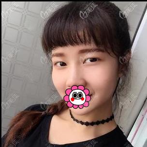 找郭光烨做双眼皮前 找郭光烨做双眼皮前