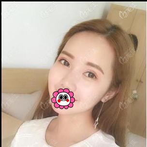 宁波郭光烨做双眼皮手术怎么样？看我花了近五千元的效果如何