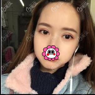 双眼皮7天拆线后 双眼皮7天拆线后