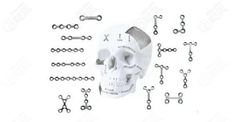 颧骨内推钛钉的材料