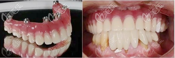 allon6种植技术案例 allon6种植技术案例