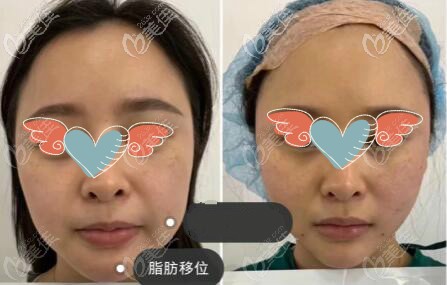 欧薇拉脂肪移位效果对比图 欧薇拉脂肪移位效果对比图