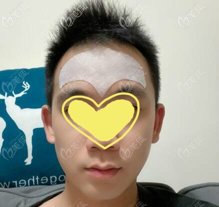 男士用抬头纹贴去除额头抬头纹照片