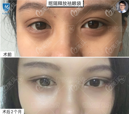 重庆百达丽别筝医生眶隔释放去眼袋效果图