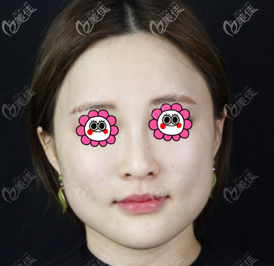 在北京星灿宫做面部吸脂前 在北京星灿宫做面部吸脂前