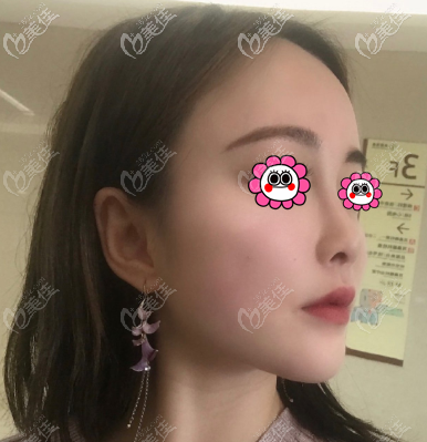 杜宁医生面部吸脂案例 杜宁医生面部吸脂案例