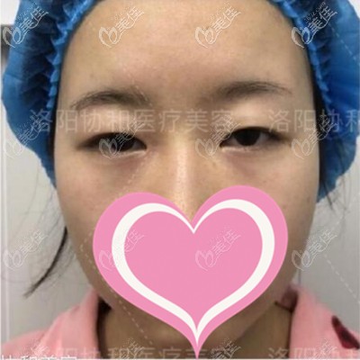 手术前眼睛小而无神 手术前眼睛小而无神