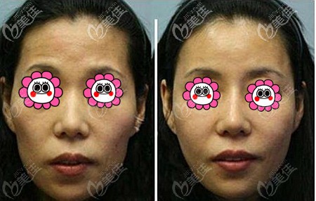 张让虎脂肪填充全脸案例