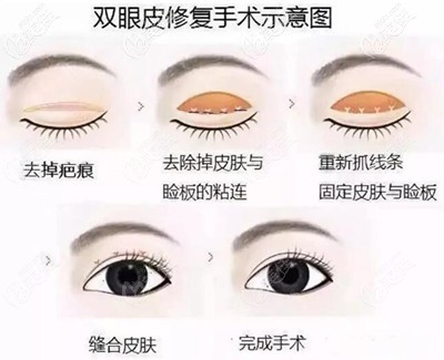 双眼皮宽改窄修复过程 双眼皮宽改窄修复过程