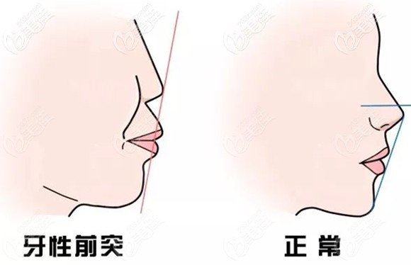 牙颌面畸形面型和正常面型对比图