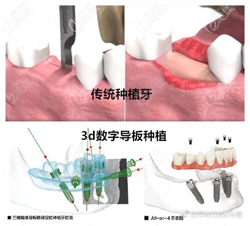 3d数字导板种植牙和普通种植牙区别