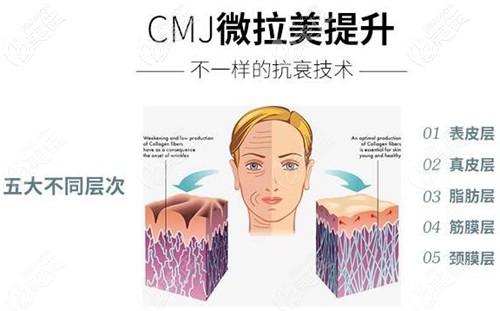 深圳曹孟君微拉美提升术