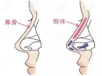 膨体隆鼻取出后多久能恢复到原样