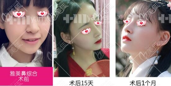 长沙雅美鼻综合真人案例