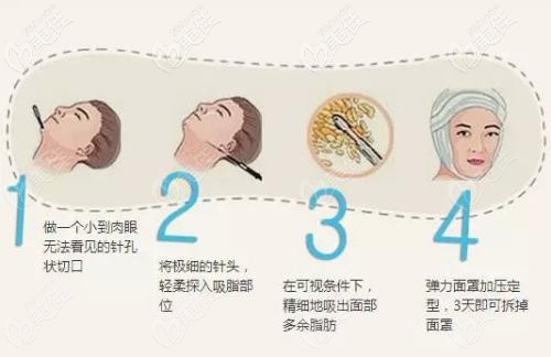 面部吸脂手术