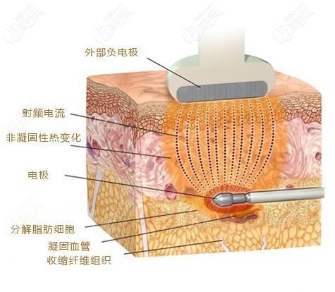 面部黄金微雕原理