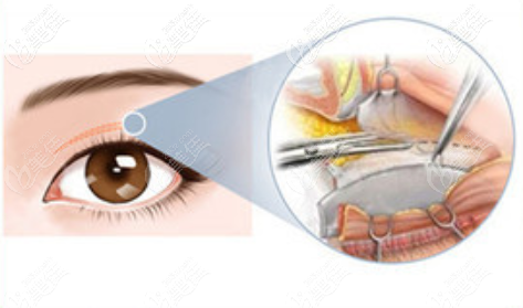 眼部手术缝合图示
