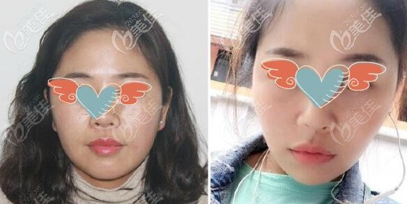 面部欧薇拉提升三个月效果图片