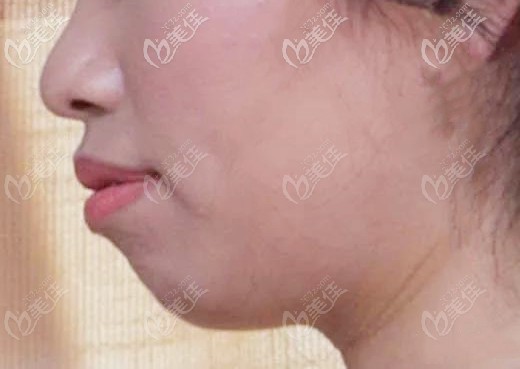 矫正前的侧面照 矫正前的侧面照