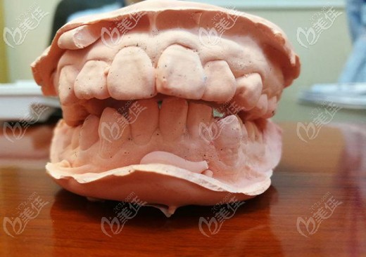 正畸前的牙齿模型图