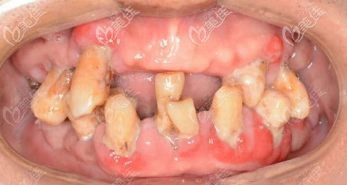 做牙齿修复前的情况 做牙齿修复前的情况