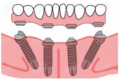 牙齿种植效果 牙齿种植效果