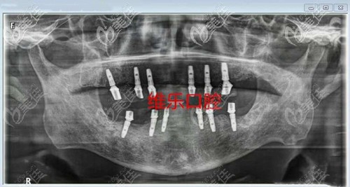 牙齿种植后的样子 牙齿种植后的样子