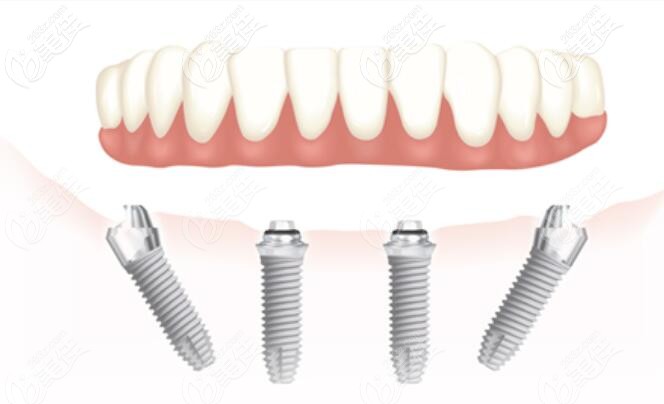 ALL-ON-4种植技术 ALL-ON-4种植技术