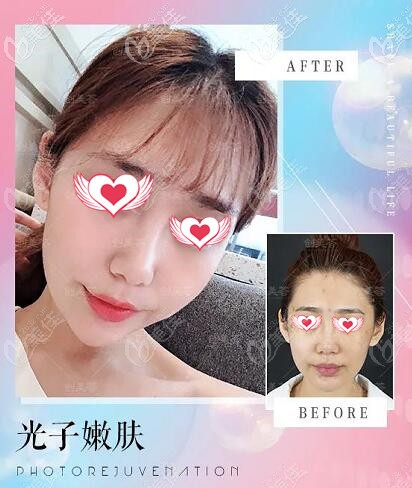 荟医疗美容光子嫩肤真人对比照 荟医疗美容光子嫩肤真人对比照
