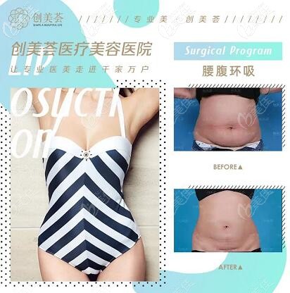 荟医疗美容腰腹环吸真人案例对比照 荟医疗美容腰腹环吸真人案例对比照