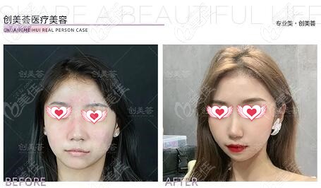 荟医疗美容敏感肌修复真实对比 荟医疗美容敏感肌修复真实对比