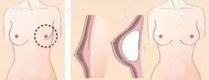 假体乳房再造示意图 假体乳房再造示意图