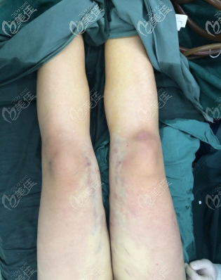 O型腿矫正术后即刻照