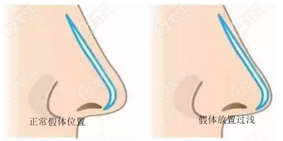 硅胶隆鼻假体应该防止的位置