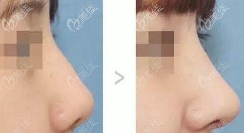 全肋骨隆鼻前后效果对比 全肋骨隆鼻前后效果对比