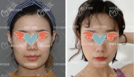 北京圣嘉新张笑天医生下颌角磨骨案例效果