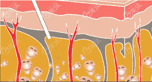 大腿吸脂手术原理