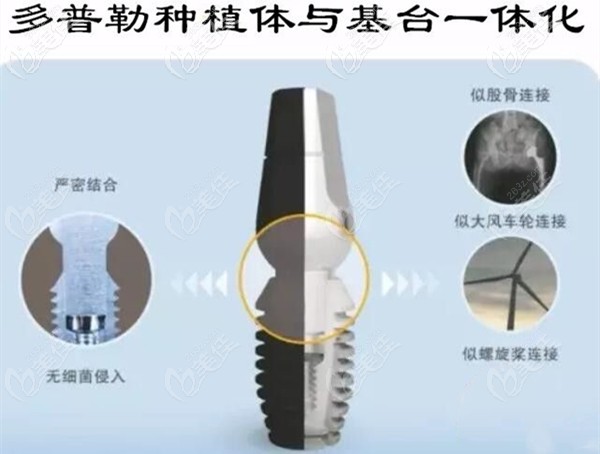 韩国duplo多普勒种植体 韩国duplo多普勒种植体