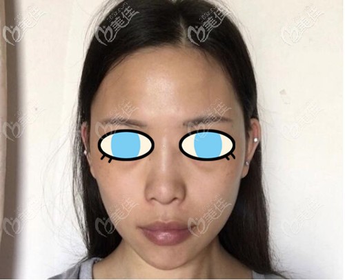 术前照片 术前照片