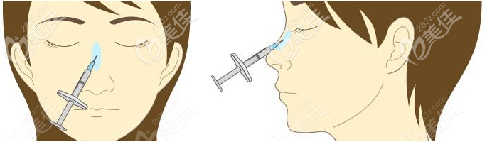 玻尿酸隆鼻和注射植骨隆鼻哪个维持时间久 玻尿酸隆鼻和注射植骨隆鼻哪个维持时间久
